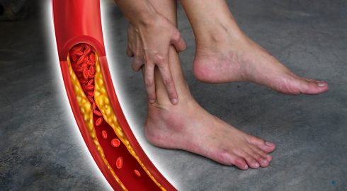Проблемы с ногами могут указывать на плохой холестерин