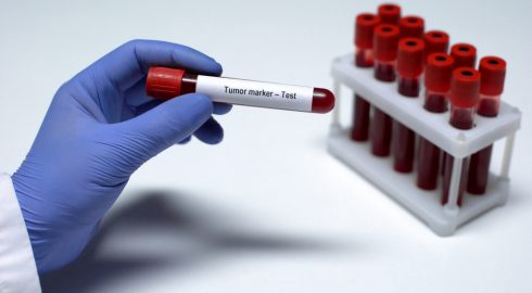 Обычный анализ крови помогает определить рак