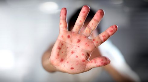 «Детская чума» уже в России: чем опасна самая заразная болезнь в мире
