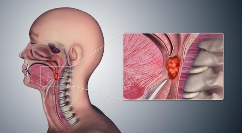 Обычный кашель или рак гортани: как отличить