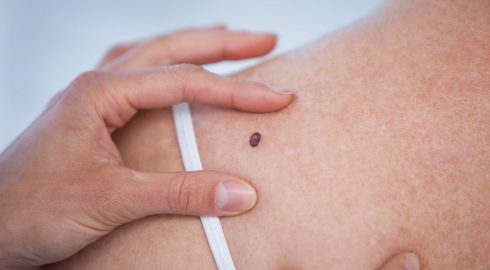 Симптомы онкологии, которые остаются без внимания: как по поту и губам можно определить рак кожи