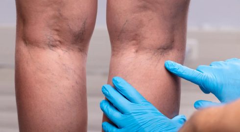 Какие симптомы могут указывать на тромб в ноге, с которым диагностировали Розенбаума