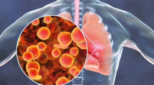 Все о вспышках вызывающей пневмонию микоплазменной инфекции: как уберечься и чем лечить