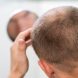 Новое средство против выпадения волос, вызванного алопецией