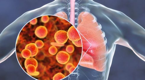Все о микоплазменной пневмонии: чем опасна и как передается