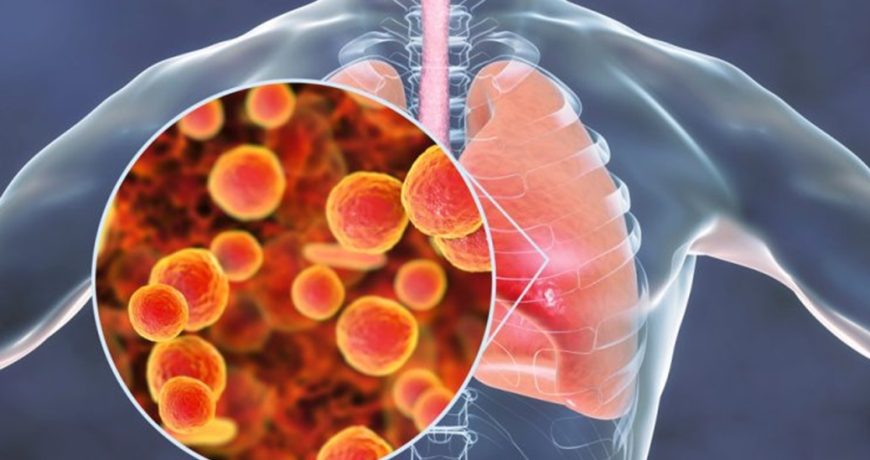 Как передаётся и чем опасна микоплазменная пневмония