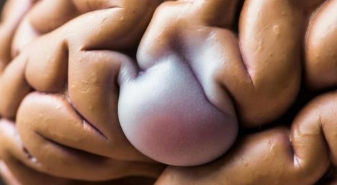 Опасность под контролем: врачи оценили шансы Ким Кардашьян на излечение аневризмы мозга